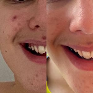 Skin Conditions 2 Acne treatment before and after photos achieved with pHformula