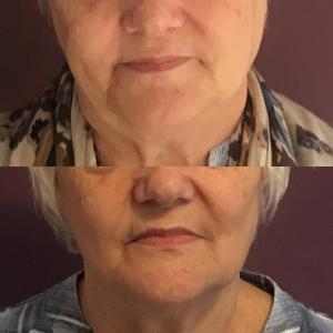 Skin Conditions 1 HIFU before and after photograph at our Chester skin clinic