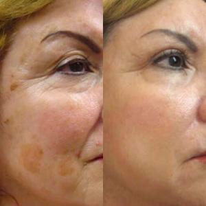 Skin Conditions 3 pHformula skin resurfacing treatment results for Skin pigmentation photographs full face showcasing the amazing results possible
