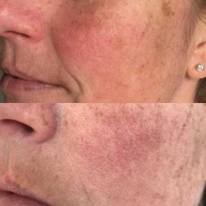 Skin Conditions 4 Rosacea treatment before and after photographs, results achieved with treatments and skin supplements