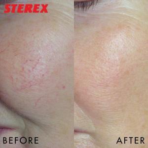 Skin Conditions 5 Thread Veins before and after photos