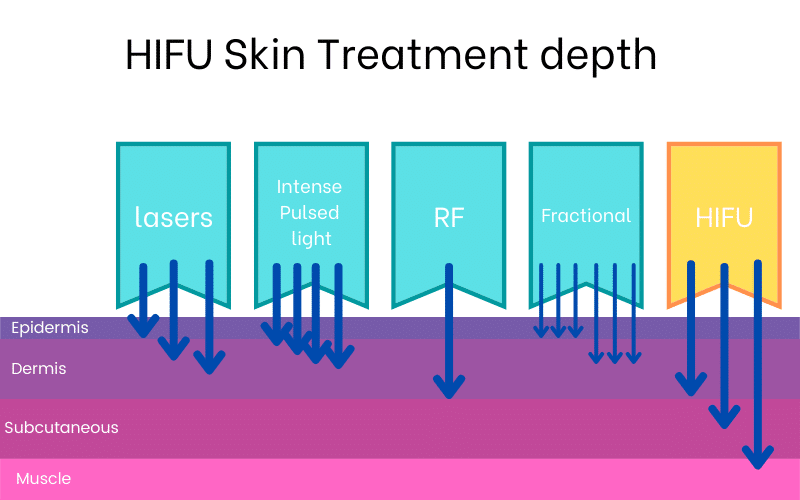 HIFU Skin Treatment depth HIFU Skin Treatment depth diagram. Covering the three layers of the skin - epidermis, dermis and subcutaneous covering the muscle. Then the different layers that the different skin treatments cover (such as laser, RF etc). The HIFU treatment reaches all three skin layers, while the other treatments only penetrate to the dermis at the very most.