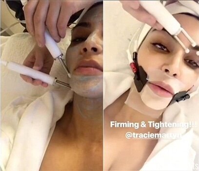 Kim Kardashian electrical facial CACI treatment Kim Kardashian electrical facial CACI treatment