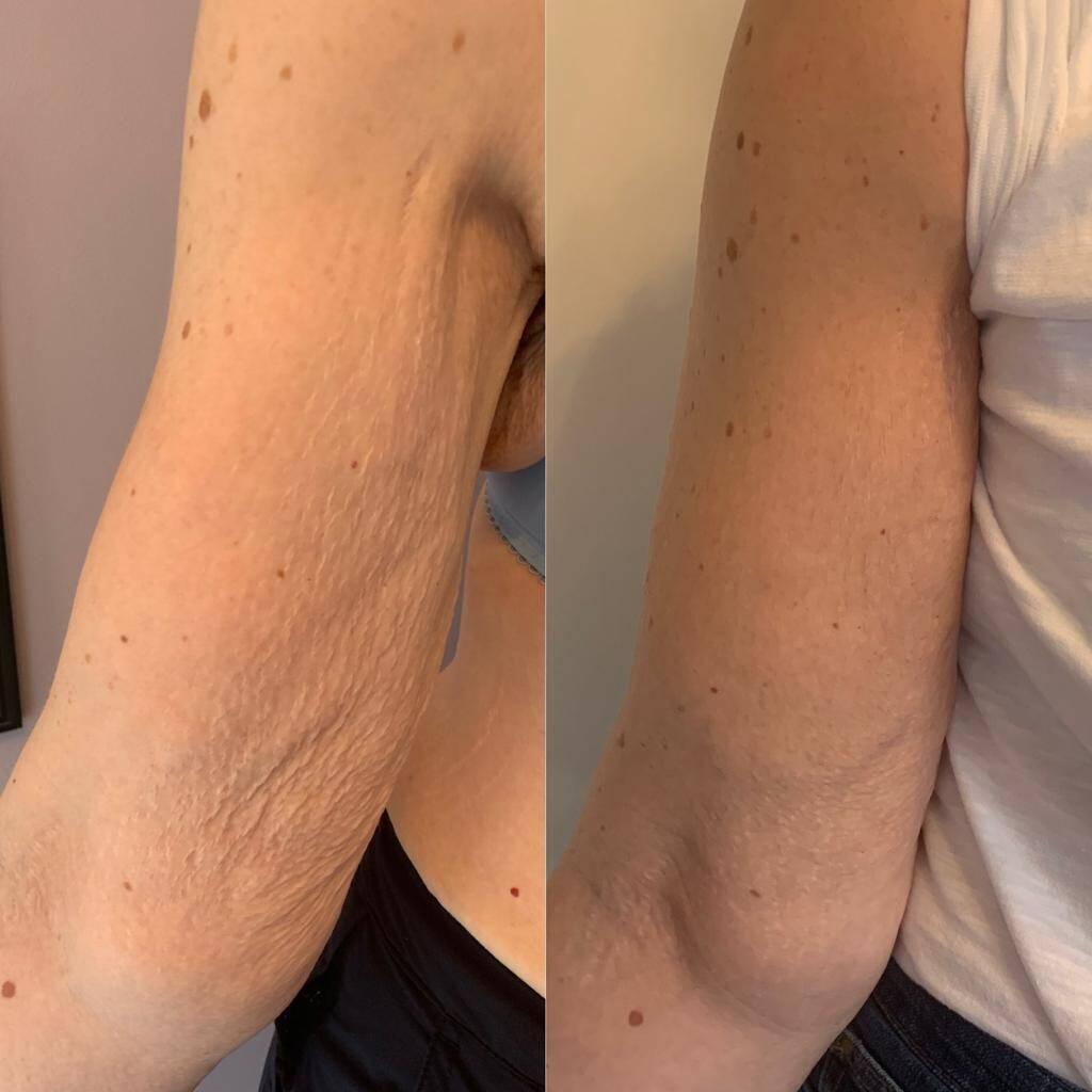 loose skin after weight loss dramatically improved as can be seen in this before and after side by side comparison.