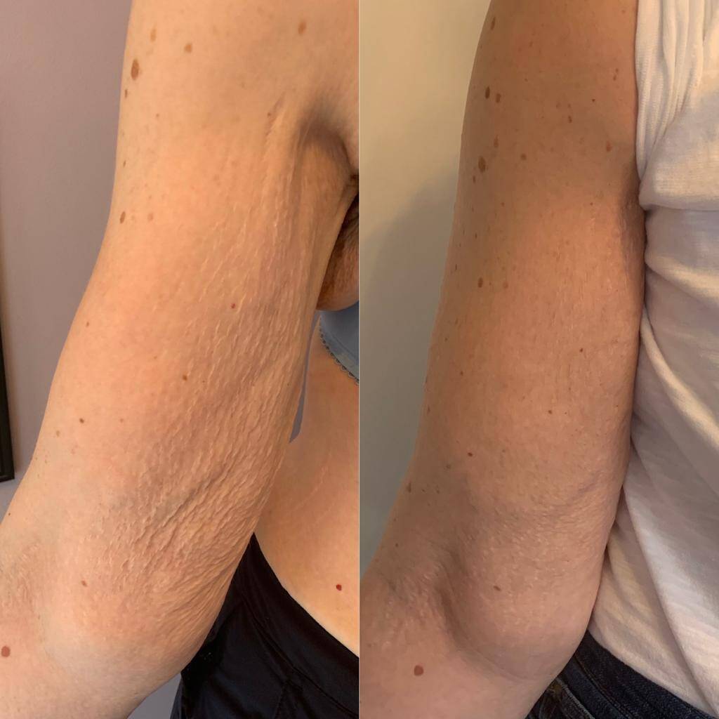 loose skin after weight loss dramatically improved as can be seen in this before and after side by side comparison.