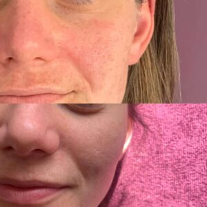 Before and after redness skin transformation plan