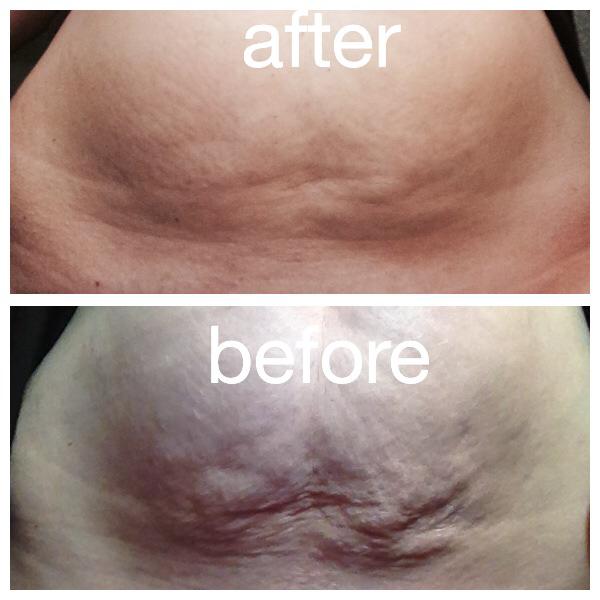 How do you get rid of a ‘Mummy Tummy’. 2 mummy tummy before and after pictures