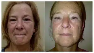 Fusion Mesotherapy 1 before and after fusion mesotherapy eye treatment.
