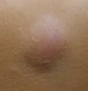 Picture of a cyst on the face. Using advanced electrolysis this can be treated. Please note this image was not taken by The Skinologists. 