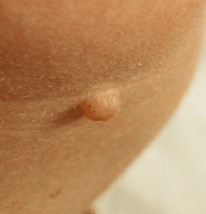 Picture showing a mole. Using advanced cosmetic procedures this can be treated. Please note this image was not taken by The Skinologists. 