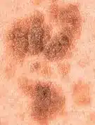 Seborrhoeic Keratosis. Using advanced cosmetic procedures this can be treated. Please note this image was not taken by The Skinologists. 