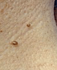 Picture of a skin tag. Using advanced cosmetic procedures this can be treated. Please note this image was not taken by The Skinologists. 