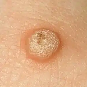 Picture of a wart before treatment. Using advanced electrolysis this can be treated. Please note this image was not taken by The Skinologists. 