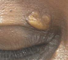 Picture of xanthelasma. Using advanced cosmetic procedures this can be treated. Please note this image was not taken by The Skinologists. 