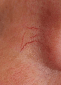 Picture of thread veins or telangiectasia. Using advanced electrolysis this can be treated. Please note this image was not taken by The Skinologists. 