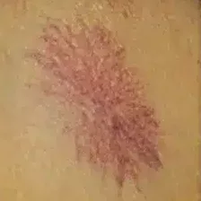 Spider nevus cropped jpg e1694167915137