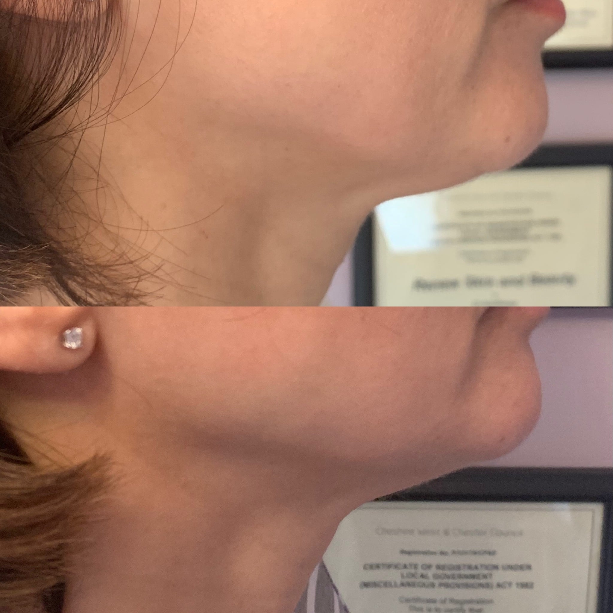 HIFU - Cheshire Face Lift 9 HIFU results in the image of a jowl lift before and after.