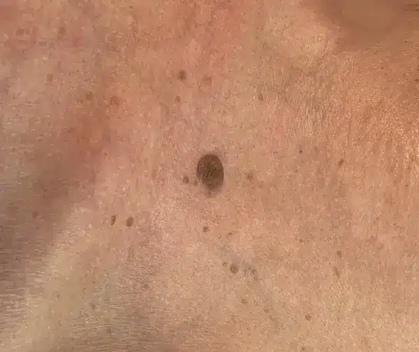 Close up photo of a skin tag. Taken at the Skinologists Chester skin clinic. This is of a client and while you cannot identify them from this image, we refuse the right for anyone for any purpose. Copyright The Skinologsts.