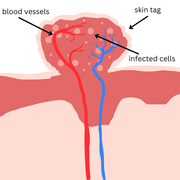 Skin tag blood flow diagram showing that blood vessels are present in tags with the infected cells. This can lead to excessive bleeding if cut off at home with something like nail clippers or scissors.