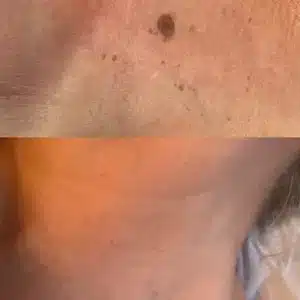 Skin tag treatment before and after photo. The top image shows the the skin tag, while the image underneath shows it has completely vanished with no marking on the skin!