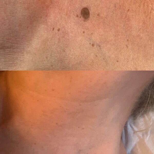 Skin tag treatment before and after photo. The top image shows the the skin tag, while the image underneath shows it has completely vanished with no marking on the skin!