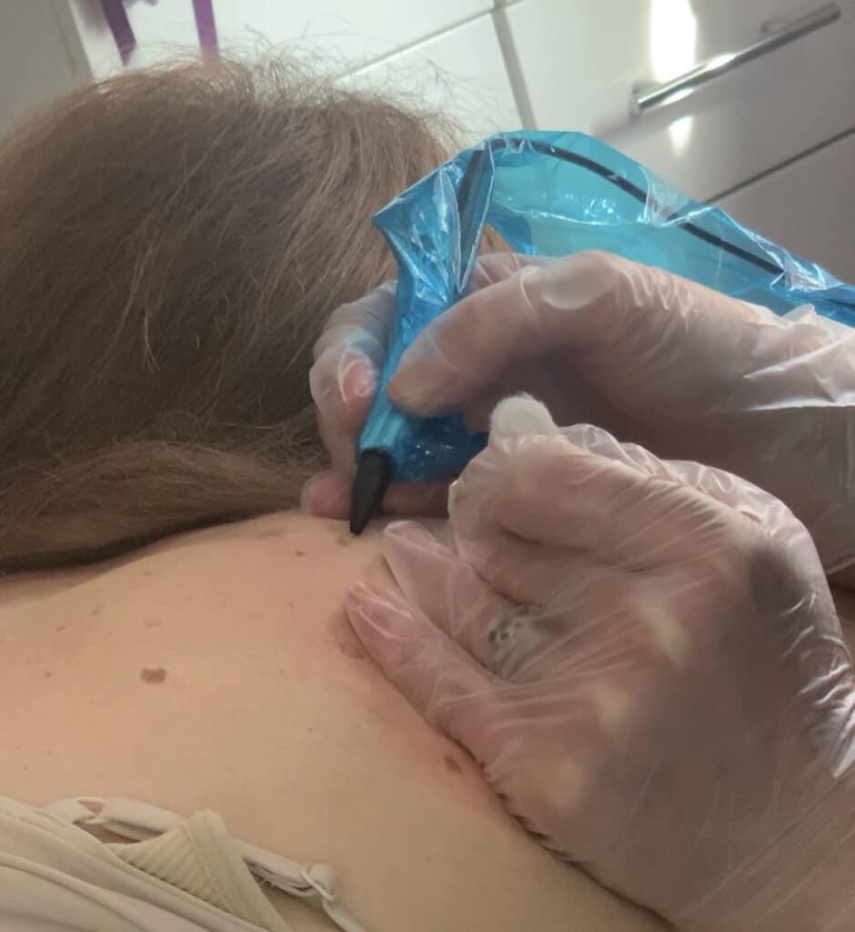 Fiona performing blemish removal on client also known as ACP