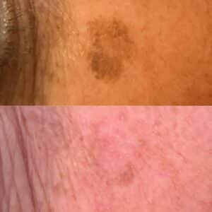 Before and after photo of age spot removal using ACP.