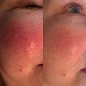 Picture of before and after thread vein removal. using ACP